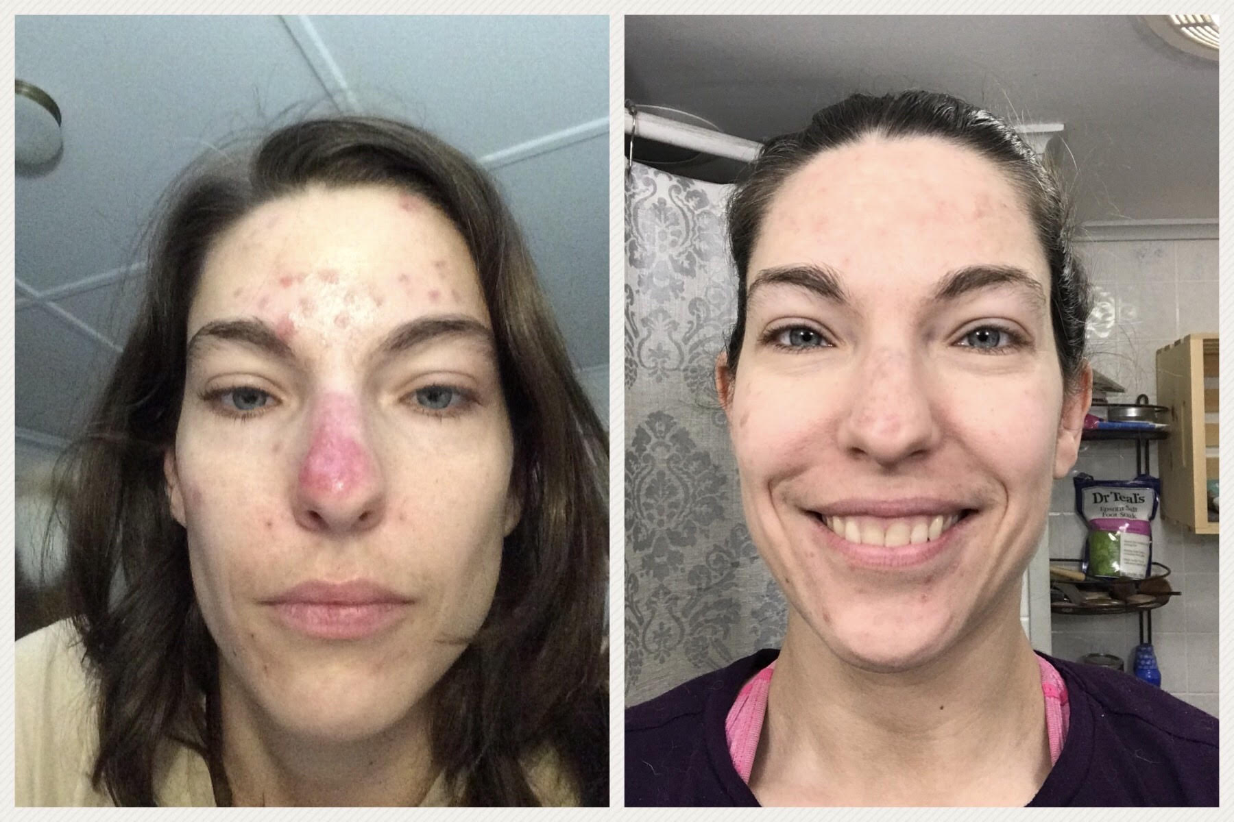 Living with Lupus: How MacKenzie Reached a Healthy Weight